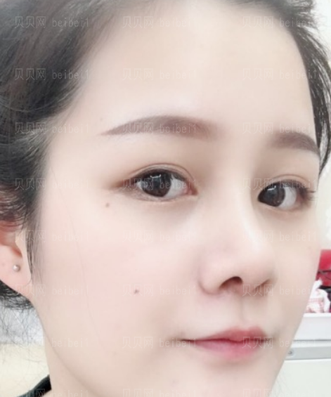 贵州省人民医院隆鼻手术介绍果怎么样?