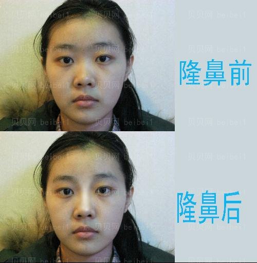 厦门中山医院隆鼻价格一般在多少钱区间?那位医生做的好?