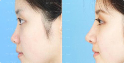 上海喜美医院隆鼻隆鼻价格大概是多少钱呢?有吗?