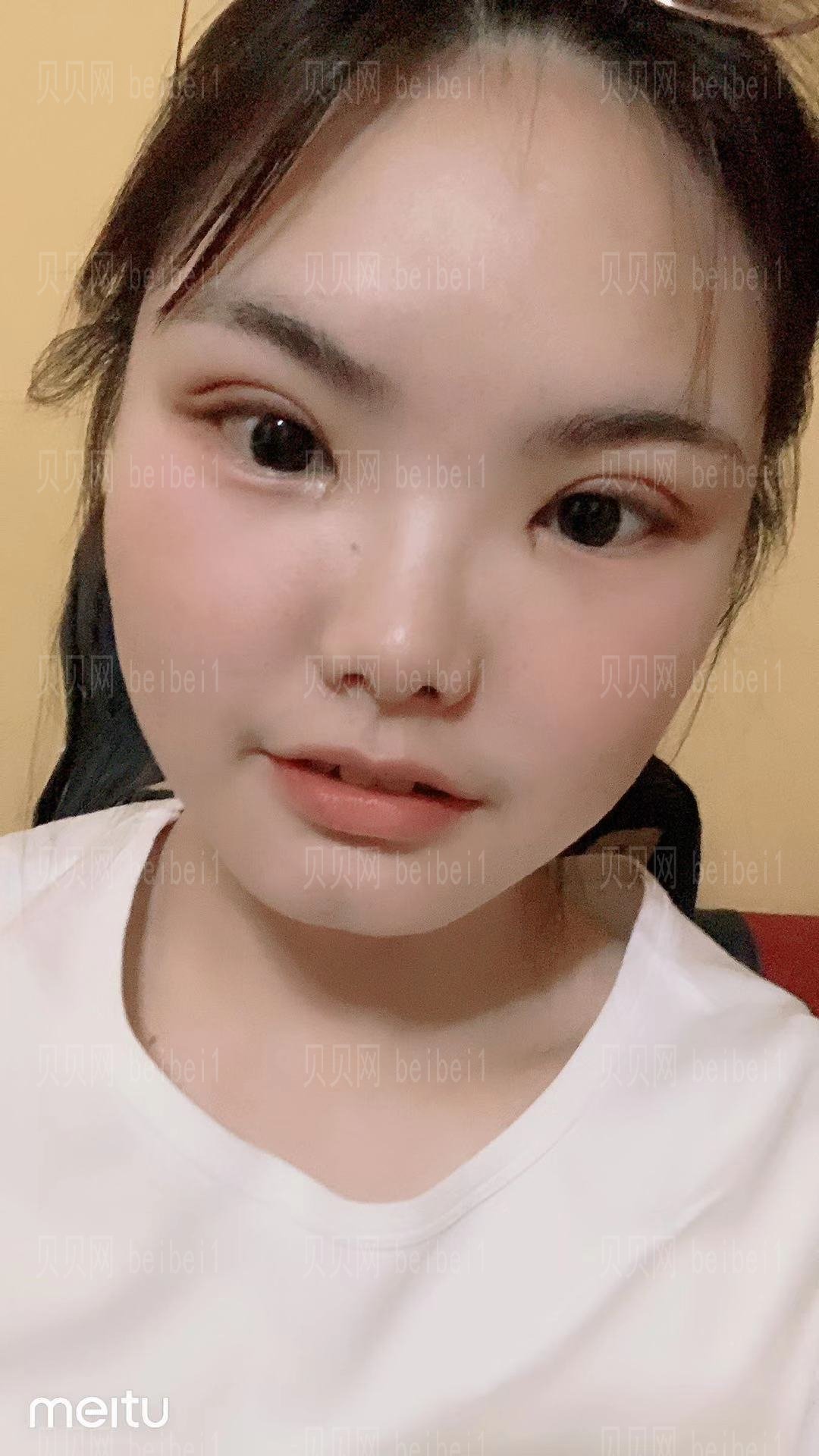济宁壹美整形美容医院好吗?割双眼皮技术怎么样?