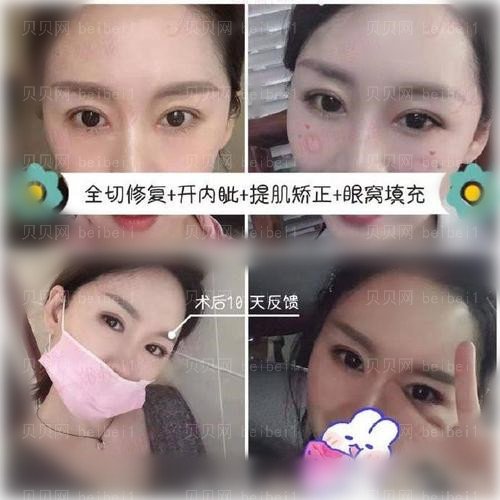 孟明星双眼皮修复价格一般在多少钱区间？