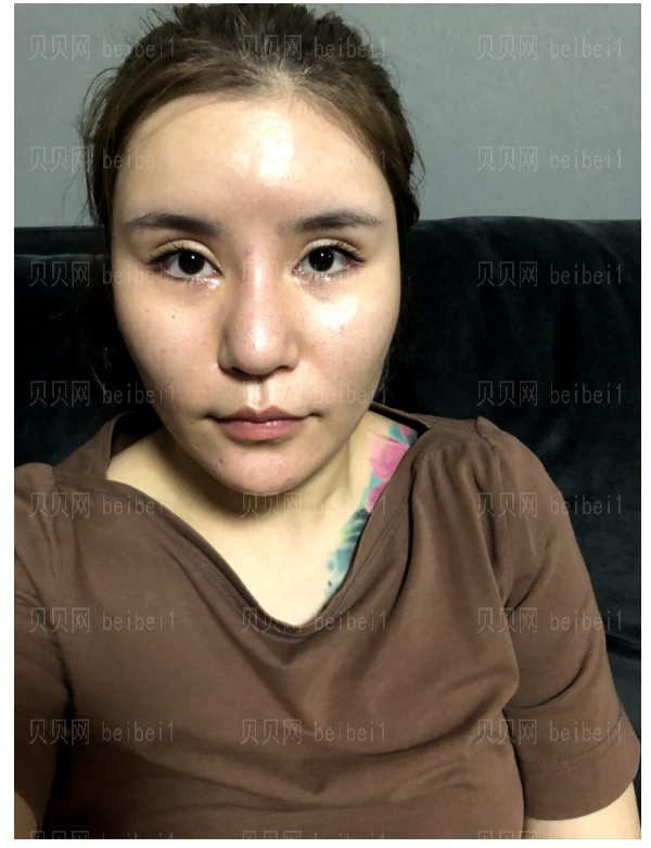 上海艺星整形医院那个医生做眼袋做的好？介绍果怎么样？