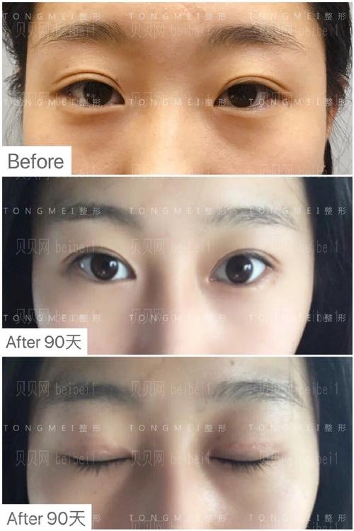 刘风卓修复双眼皮口碑怎么样