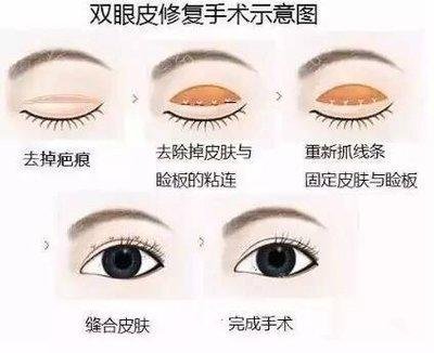 刘风卓修复双眼皮口碑怎么样