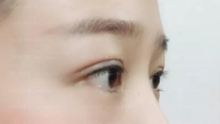 上海九院王梓双眼皮介绍