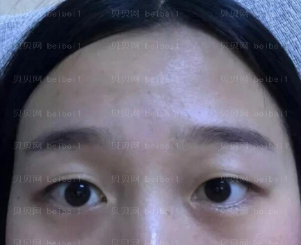 上海九院王梓双眼皮介绍
