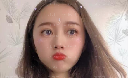 上海九院王梓双眼皮介绍