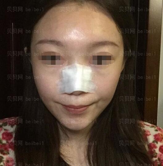 武汉艺龄医疗美容医院隆鼻怎么