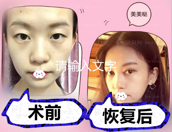 镇江市第一人民医院徐斌双眼皮怎么样