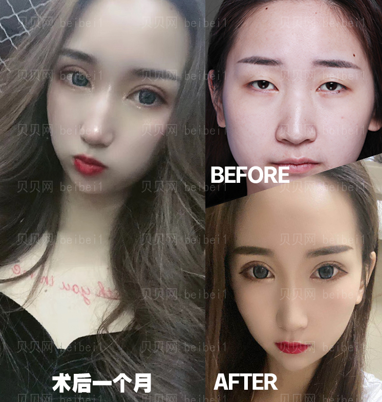 刘志刚眼修复技术怎么样双眼皮修复介绍分享