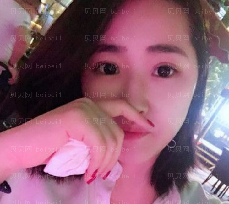 潘贰双眼皮修复介绍