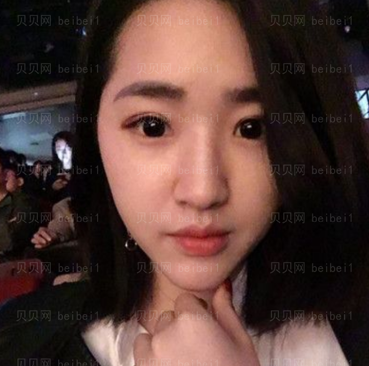 潘贰双眼皮修复介绍