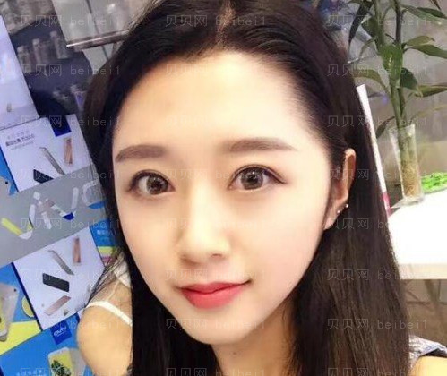 张冰洁修复双眼皮技术靠谱吗?果怎么样?