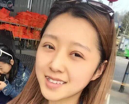 张冰洁修复双眼皮技术靠谱吗?果怎么样?
