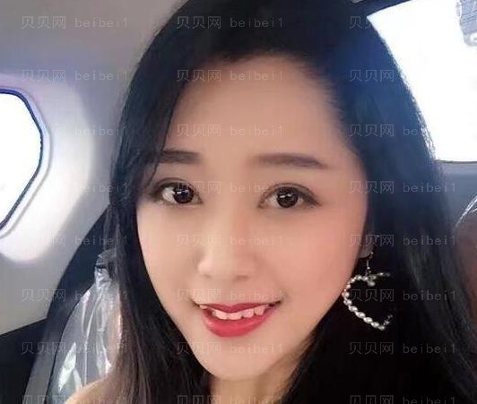 张冰洁修复双眼皮技术靠谱吗?果怎么样?