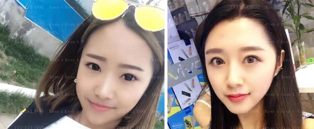 张冰洁修复双眼皮技术靠谱吗?果怎么样?