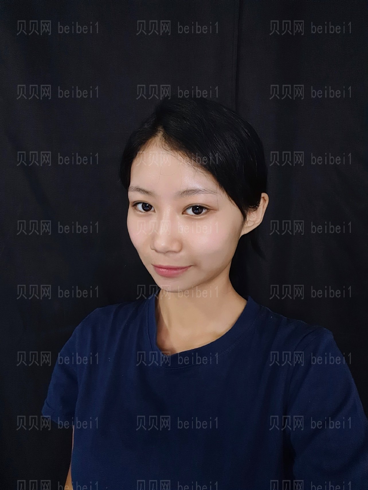 颧骨颧弓内推下调 下颌角磨骨介绍分享