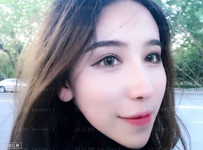 丁洪如做眼睛怎么样?双眼皮介绍果怎么样?