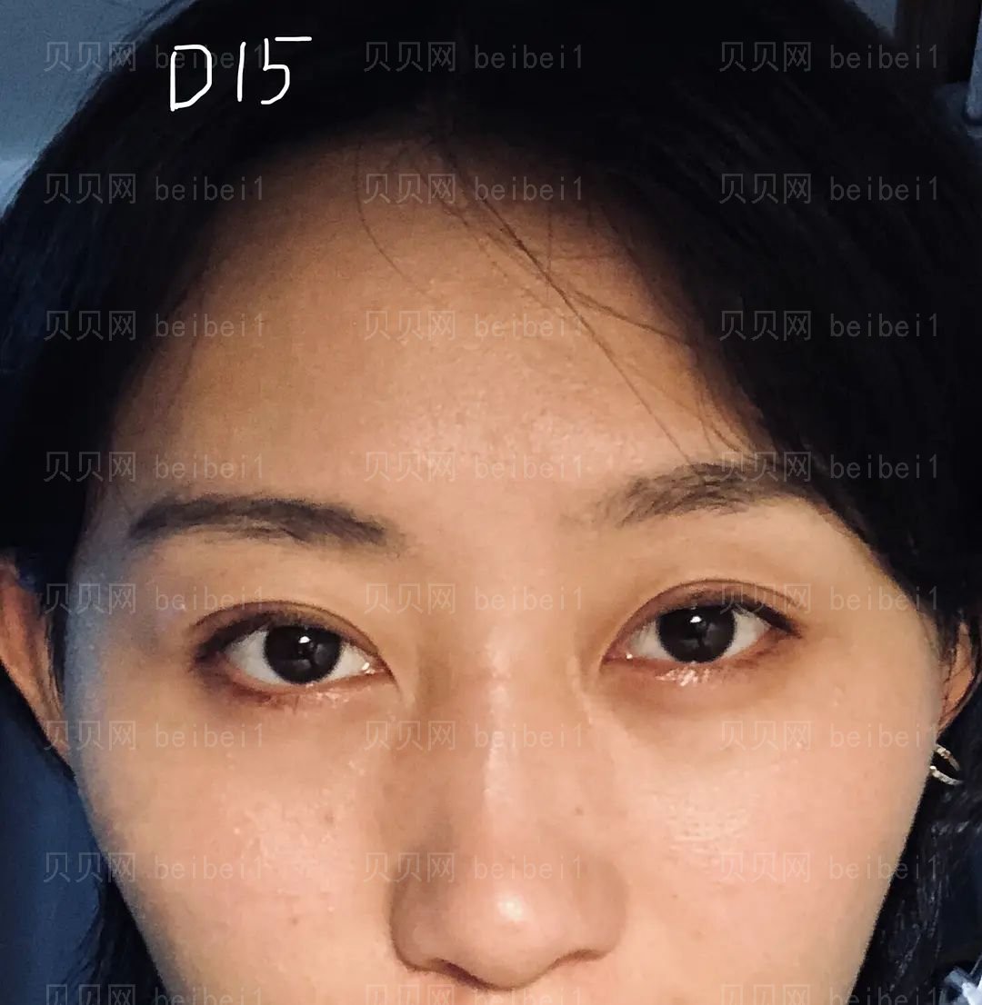 广州潘贰双眼皮介绍