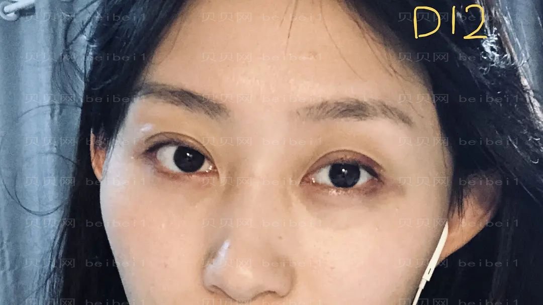 广州潘贰双眼皮介绍