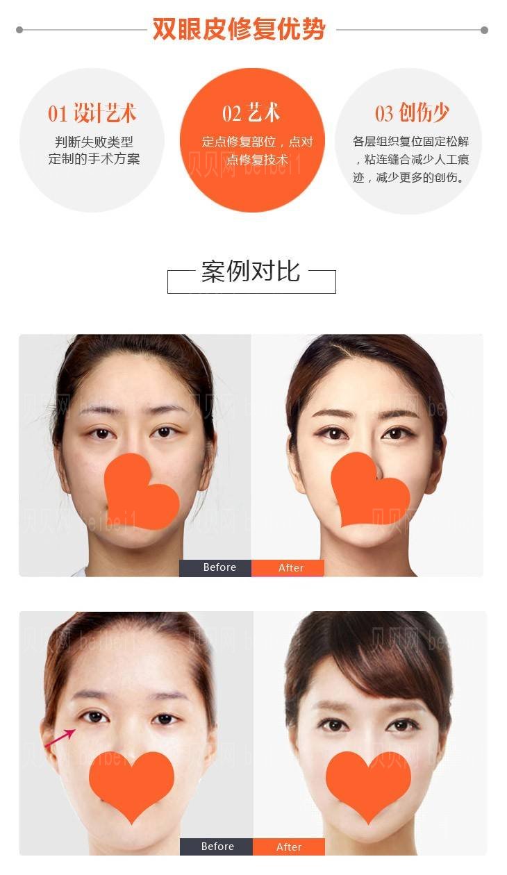 靳小雷双眼皮修复价格