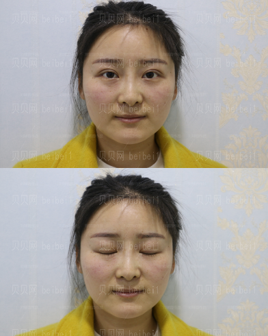 刘辅容双眼皮修复好吗？技术怎么样？
