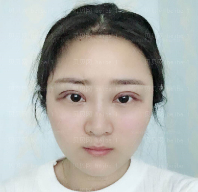 刘辅容双眼皮修复好吗？技术怎么样？