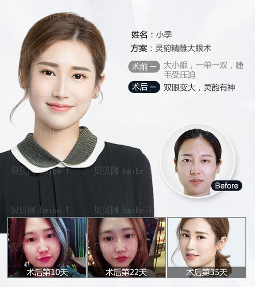 西安画美罗曼割双眼皮怎么样