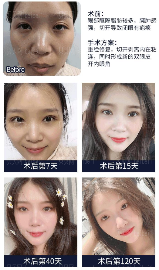 孟明星双眼皮修复怎么样