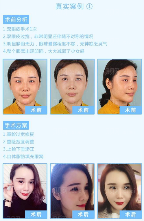 闫家峰做双眼皮怎么样