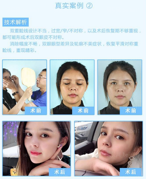 闫家峰做双眼皮怎么样