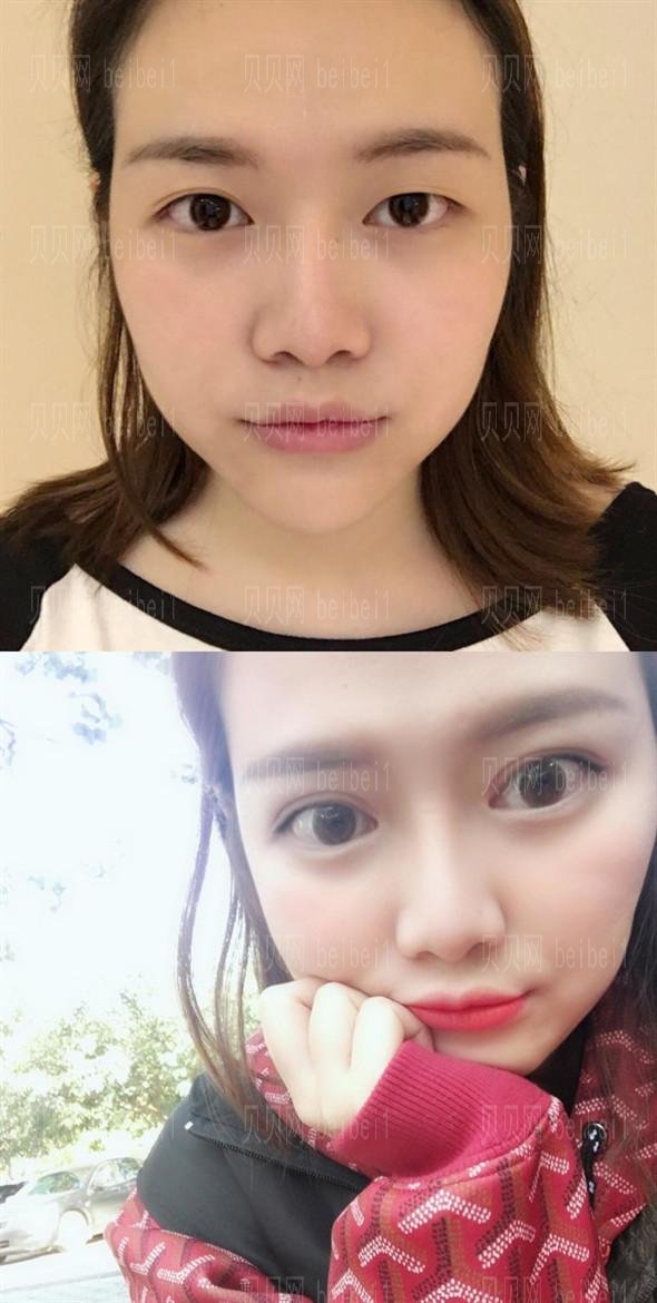 成都米兰柏羽高亮割个双眼皮技术怎么样？