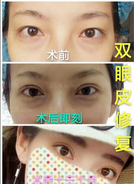 金鑫双眼皮修复怎么样?好吗?