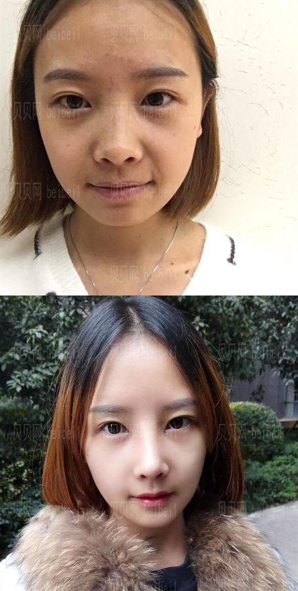 成都米兰柏羽高亮割个双眼皮技术怎么样？