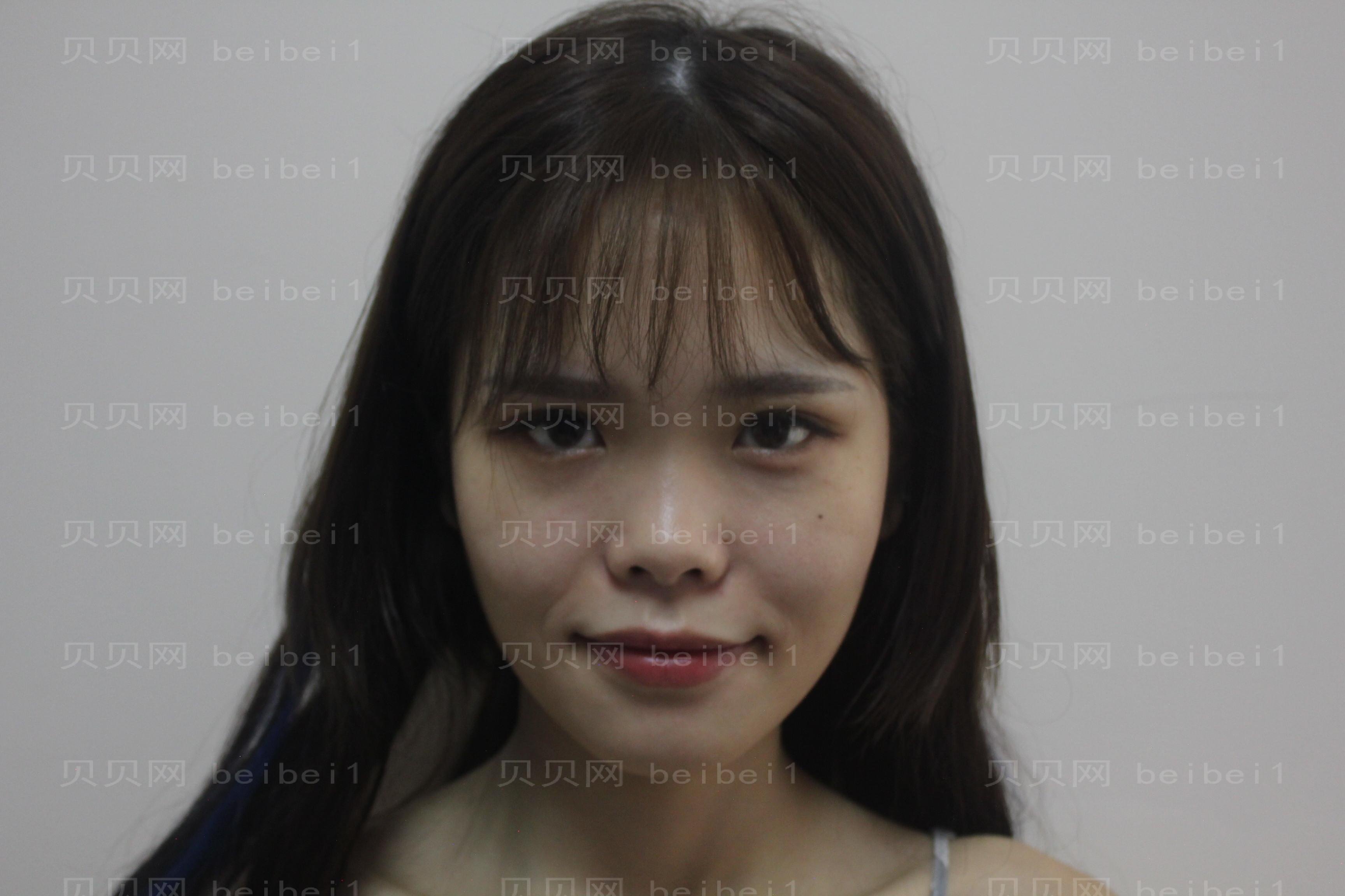 车红昌做眼睛怎么样?成都西区医院双眼皮介绍