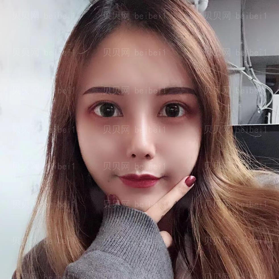 车红昌做眼睛怎么样?成都西区医院双眼皮介绍