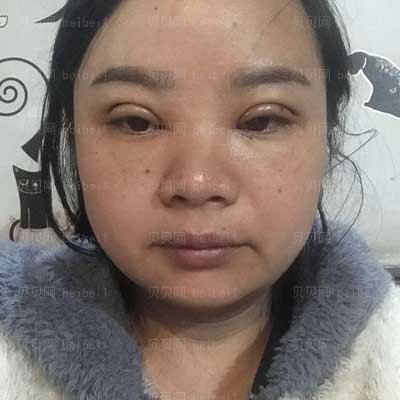 华西李正勇双眼皮做得好不?怎么样