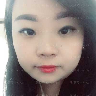 华西李正勇双眼皮做得好不?怎么样