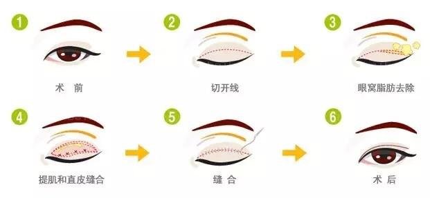 哈尔滨211医院割双眼皮大概需要多少钱才够