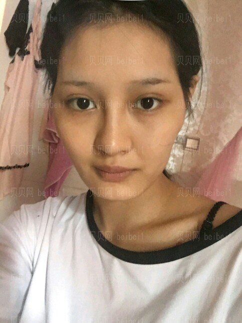 自体脂肪多方面部填充术后第216天了，周末你们一般干嘛去呢？