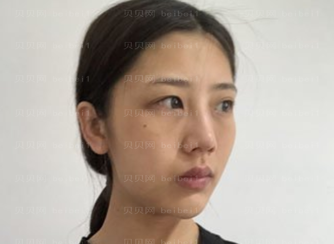 九院张英去眼袋介绍好不好看?