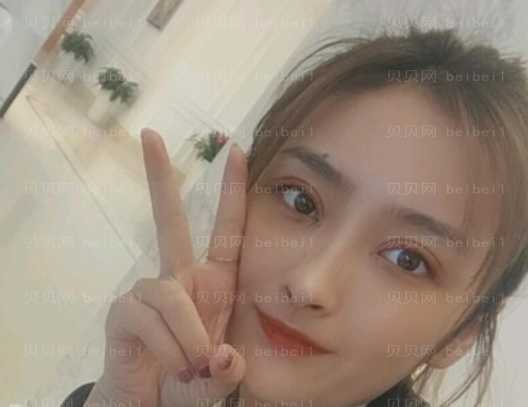 刘晓吉双眼皮介绍