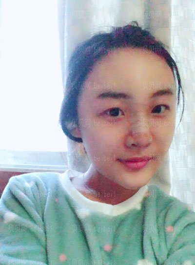 庞东剑做的隆鼻手术怎么样