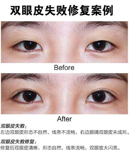 太原弓军胜双眼皮修复价格