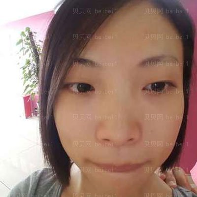 西安双眼皮宋蔚医生介绍分享