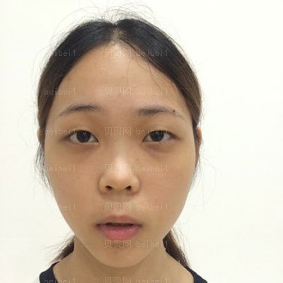 许炎龙做双眼皮怎么样