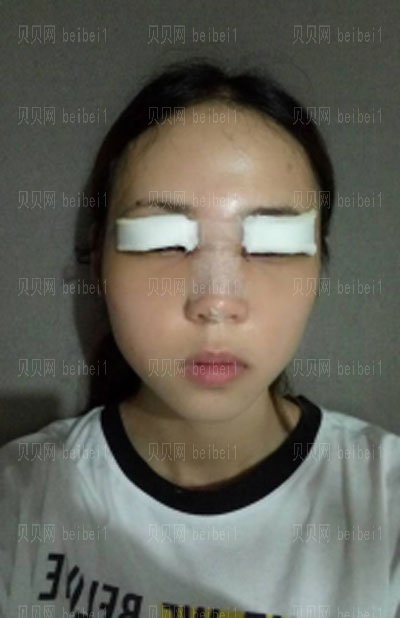 许炎龙做双眼皮怎么样