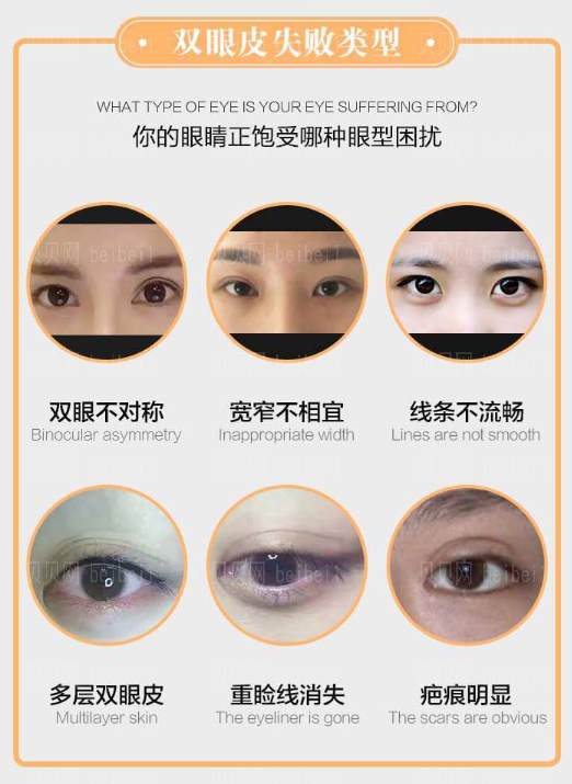 张海明医生双眼皮修复怎么样