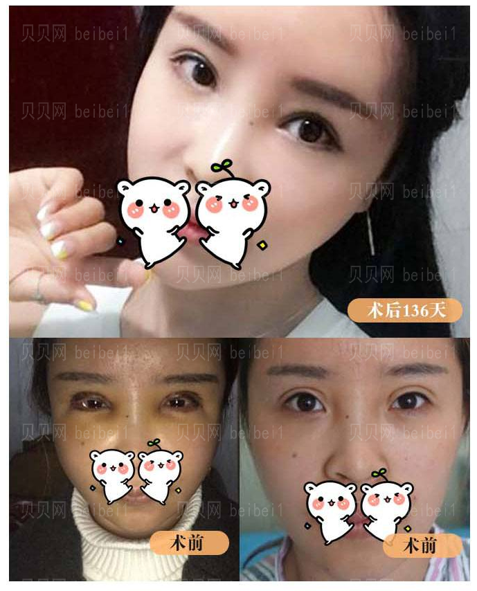 张海明医生双眼皮修复怎么样