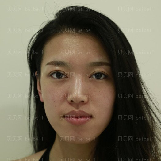 重庆郑荃丽格医疗美容李若嫣激光祛斑介绍